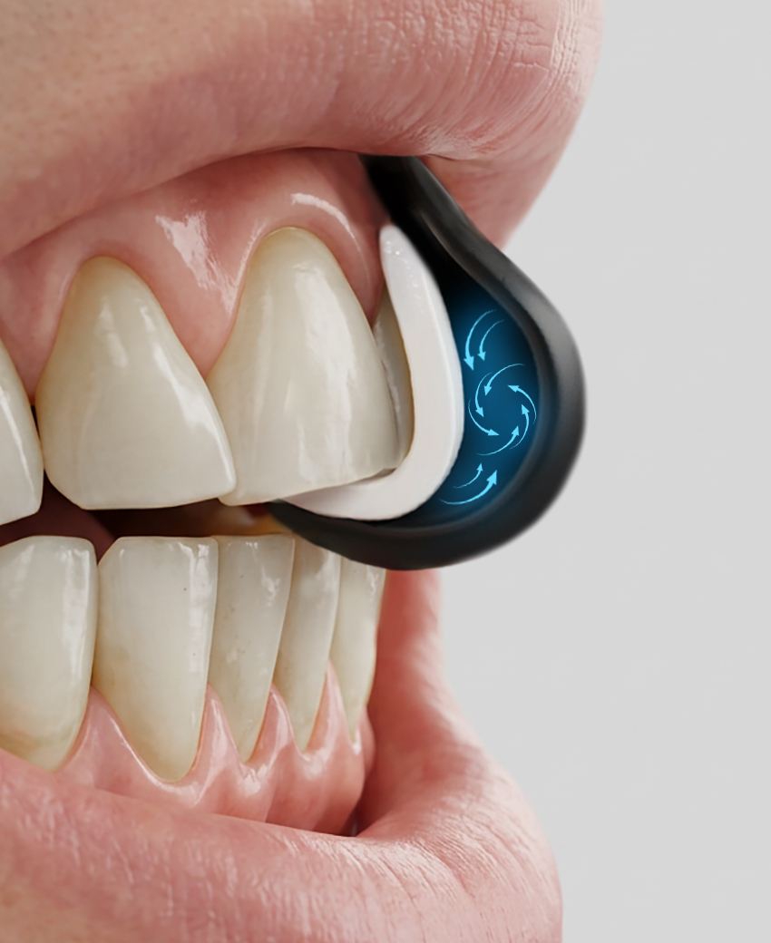 Protetor bucal personalizado GuardX Combat aplicado aos dentes